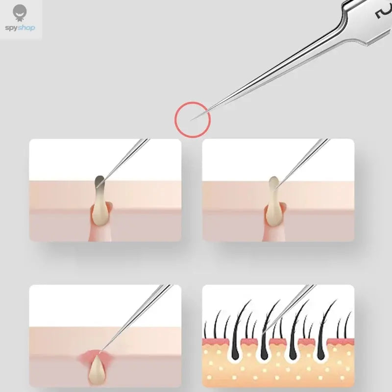 German Ultra-fine No. 5 Cell Pimples Blackhead Clip Tweezers Beauty Salon Special Scraping & Closing Artifact Acne Needle Tool Spy-shop.com