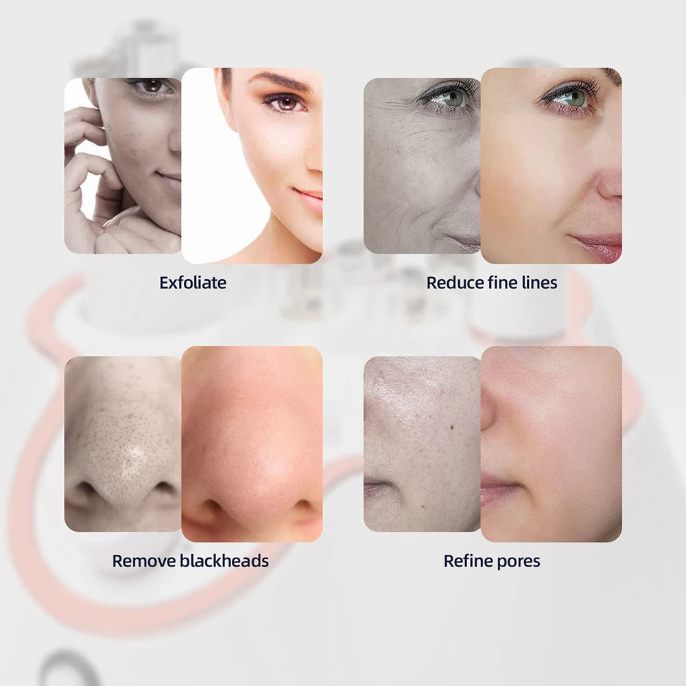 Diamantový mikrodermabrační přístroj pro hlubokou exfoliaci obličeje