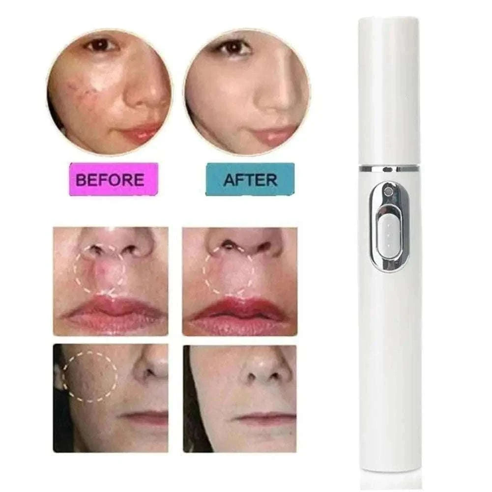 Blue Light Therapy Acne Pen for Targeted Blemish Care-1pc