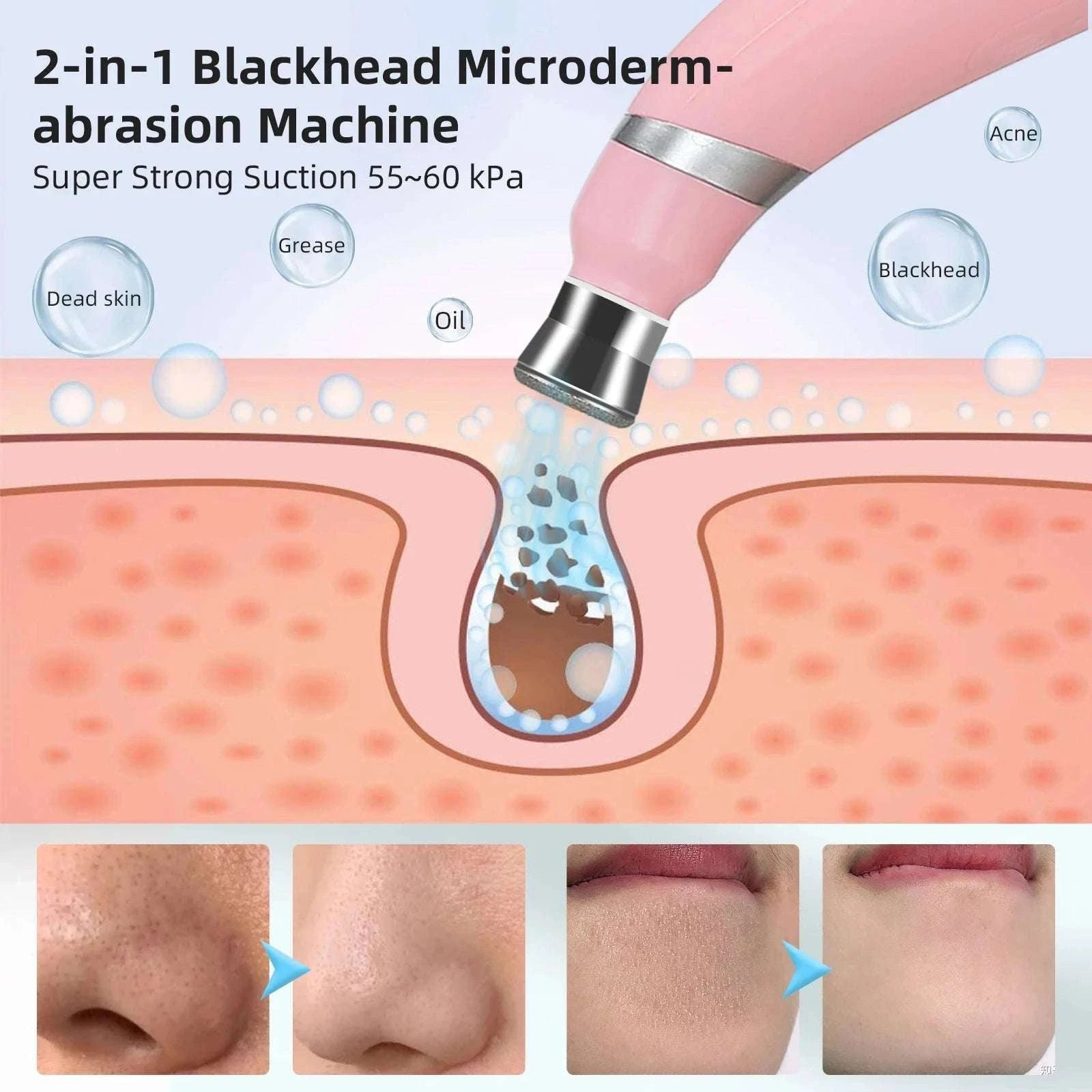 Diamond Microdermabrasion Machine for Deep Facial Exfoliation-US PLUG (100-110V)