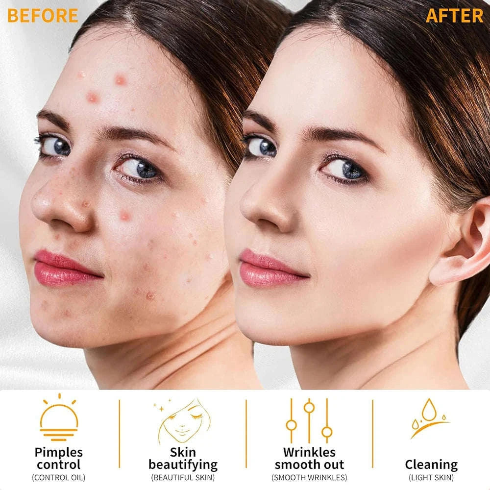 High Frequency Electrotherapy Facial Wand for Skin Rejuvenation-EU Plug