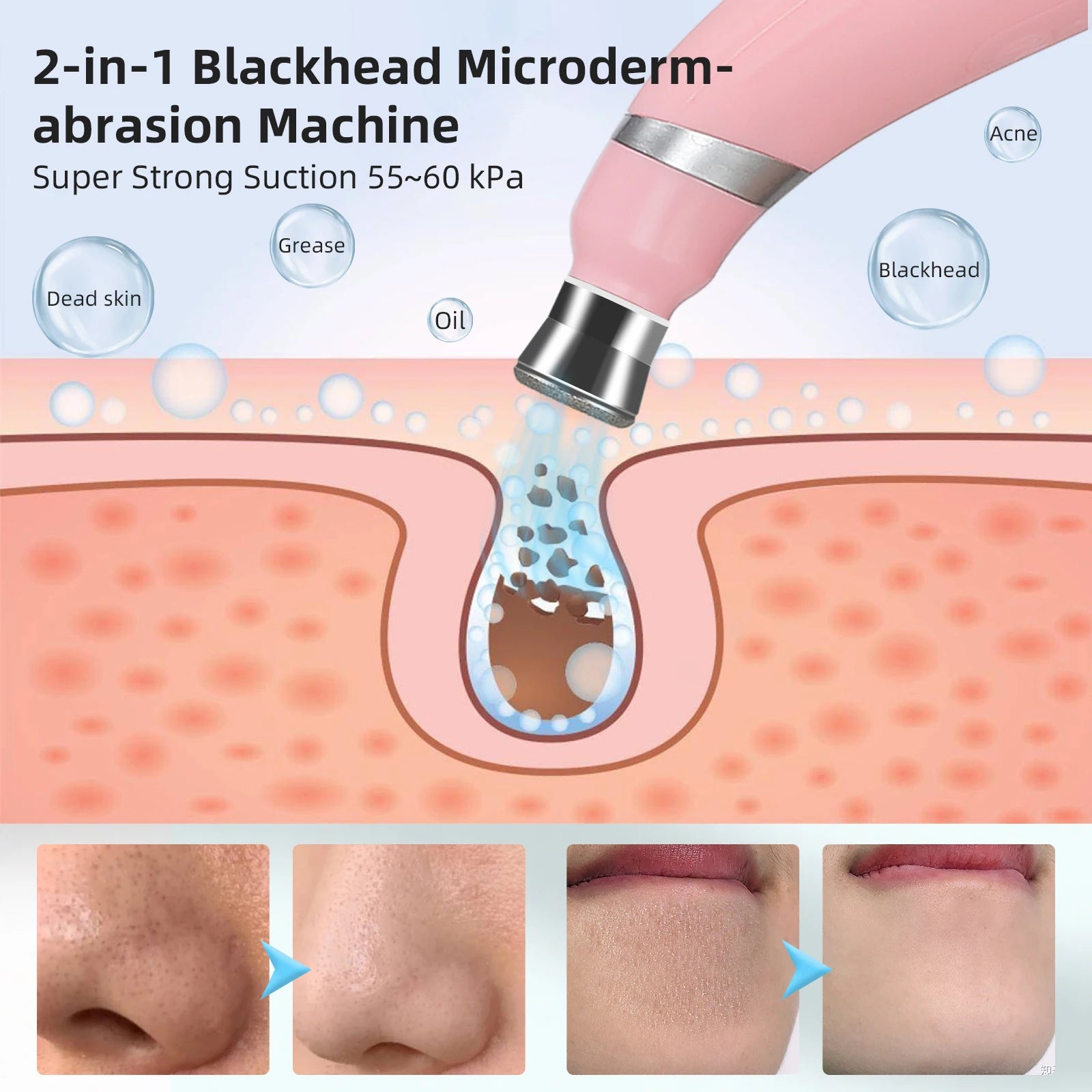 Diamantový mikrodermabrační přístroj pro hlubokou exfoliaci obličeje