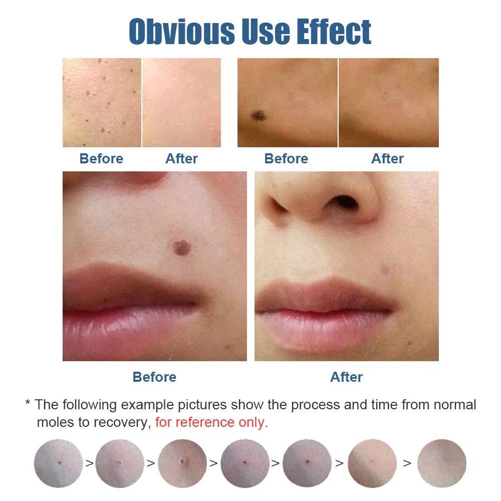 Miniaturowe urządzenie plazmowe do usuwania piegów i brodawek skórnych