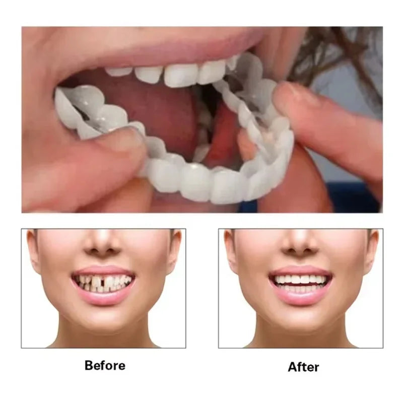 Temporary Silicone Cosmetic Tooth Covers, Upper or Lower