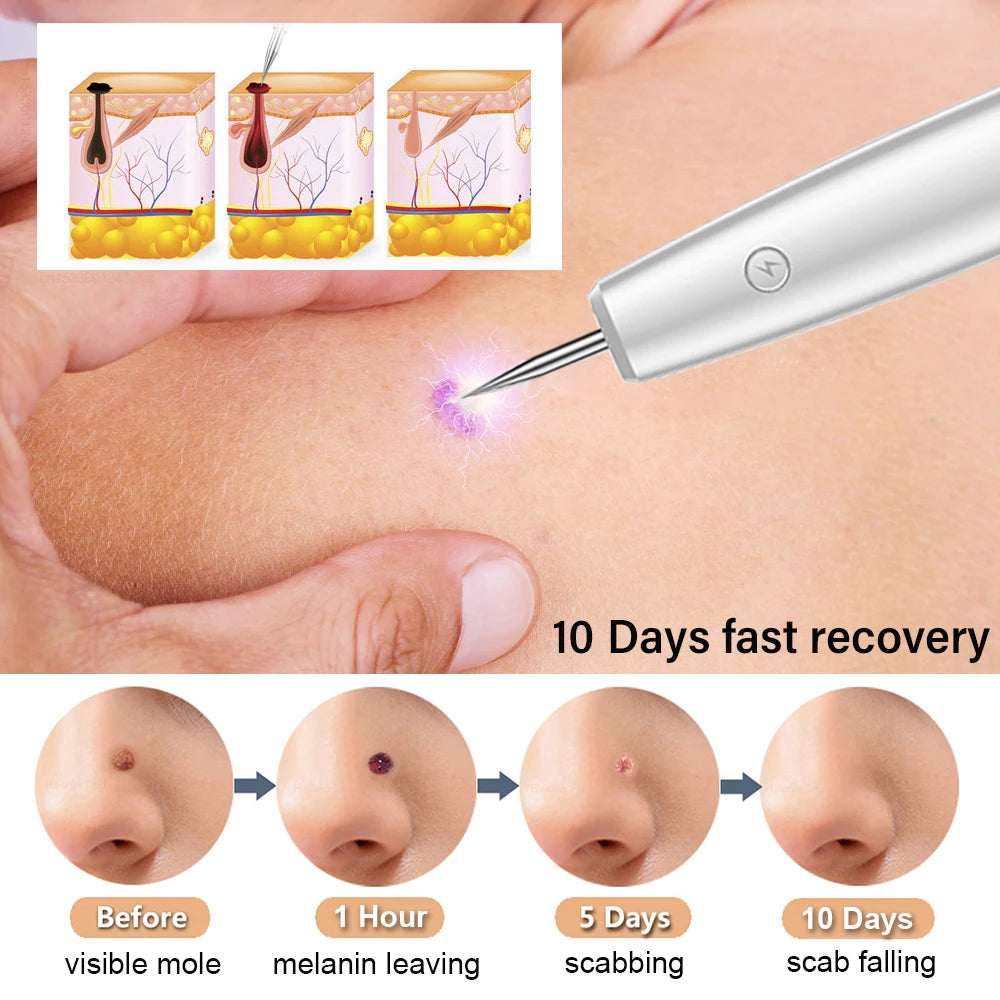 Skin Tag Remover Laser Plasma Pen Dark Spot Mole Wart Remover Pen Electric Tattoo Freckle Nevus Black Spots Skin Tag Removal 