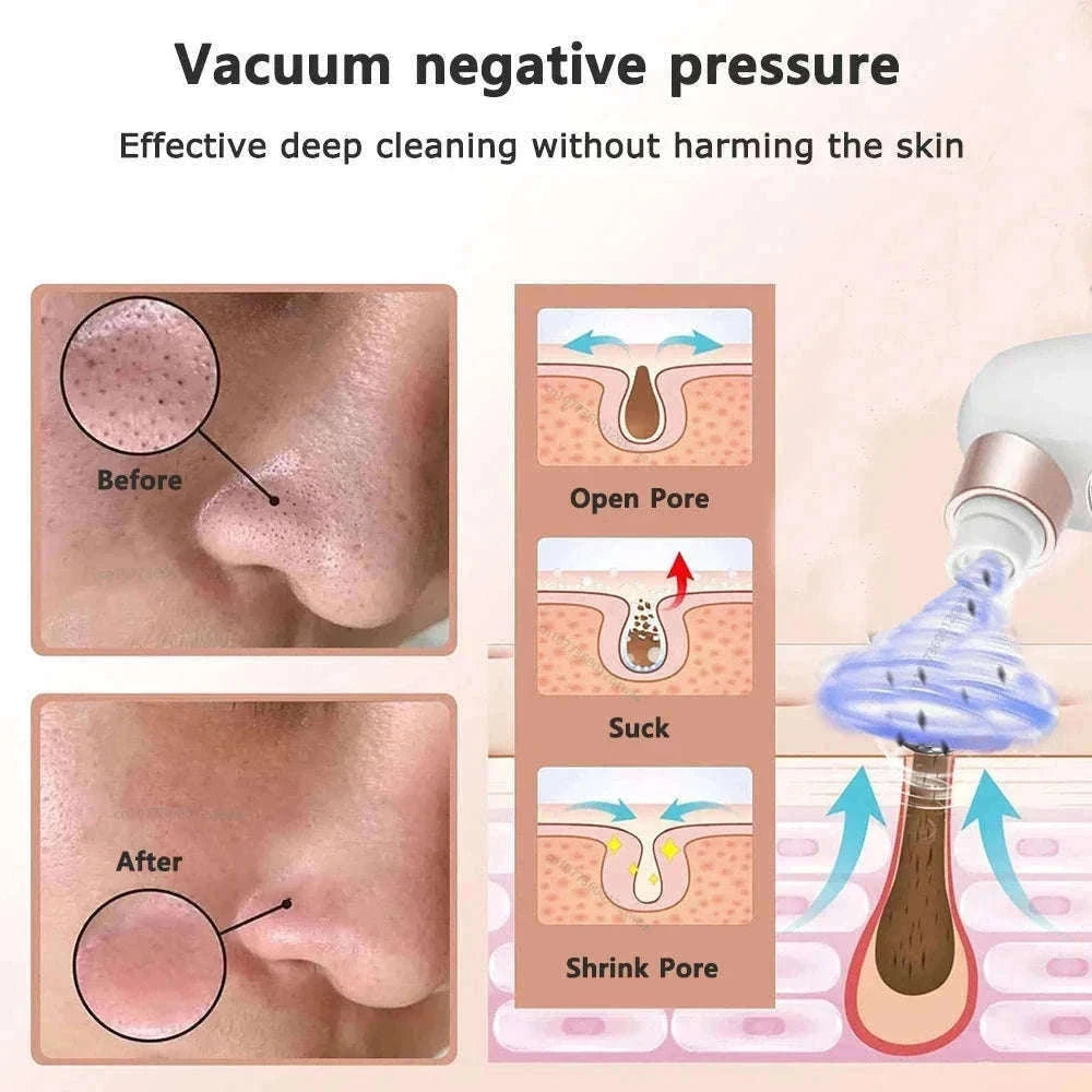 Blackhead Remover Vacuum with Water Cycle & USB Rechargeable-white add gift