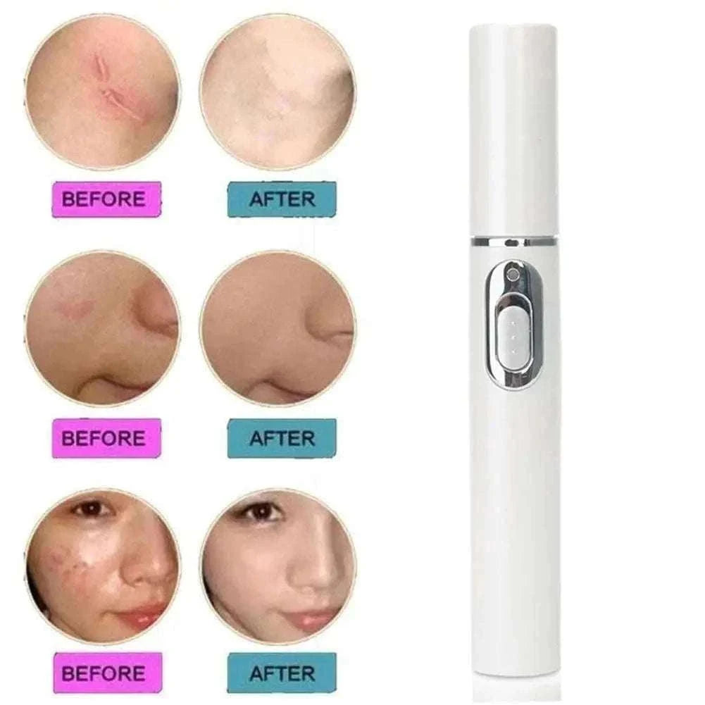 Blue Light Therapy Acne Pen for Targeted Blemish Care-1pc