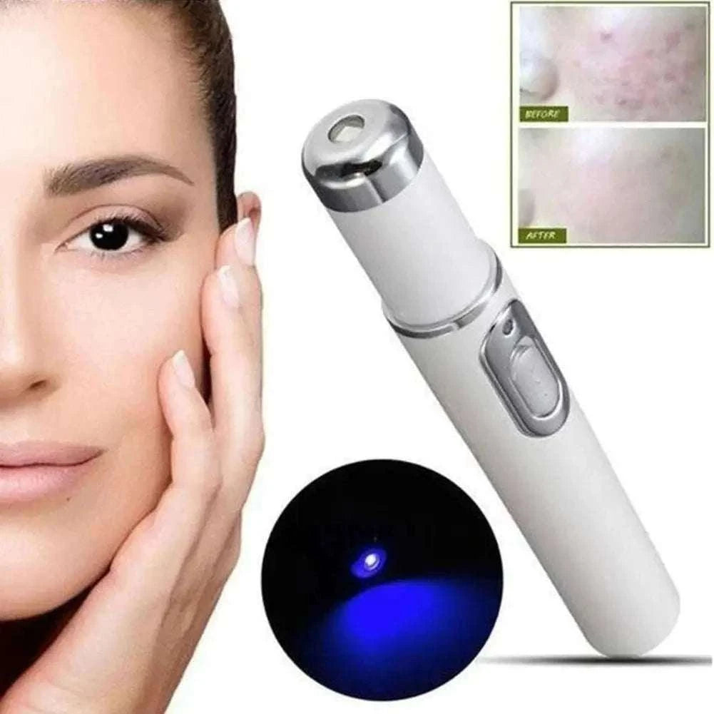 Blue Light Therapy Acne Pen for Targeted Clearer, Smoother Skin-1pc