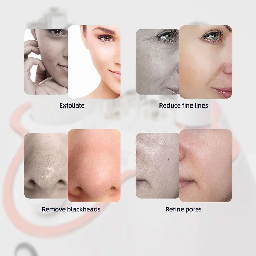Diamond Microdermabrasion Machine for Deep Facial Exfoliation-US PLUG (100-110V)
