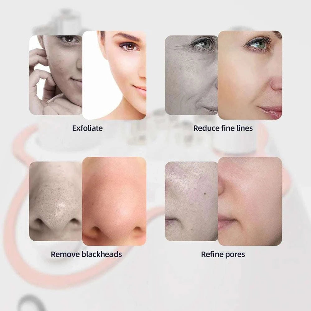 Diamond Microdermabrasion Machine for Deep Facial Exfoliation-US PLUG (100-110V)