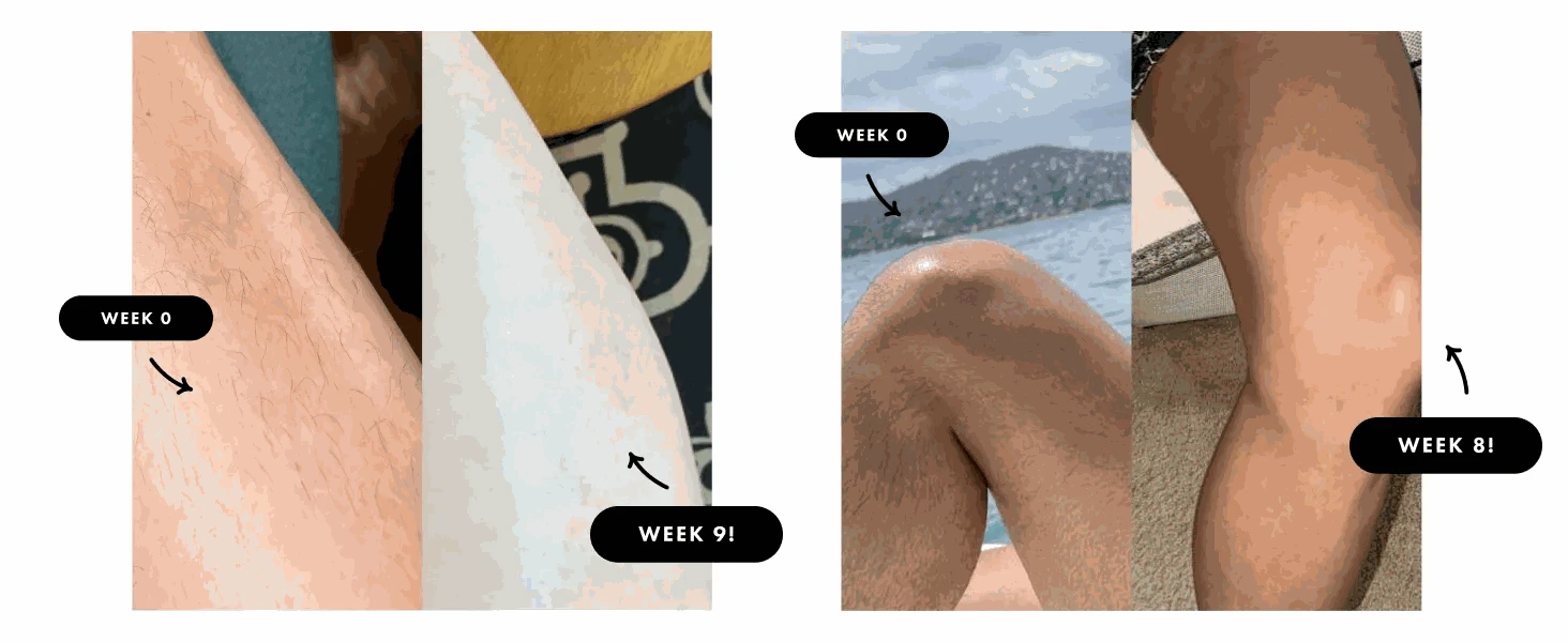 IPL Hair Removal Device with 999,900 Flashes for Full-Body Use-AI01D / US Plug / United States