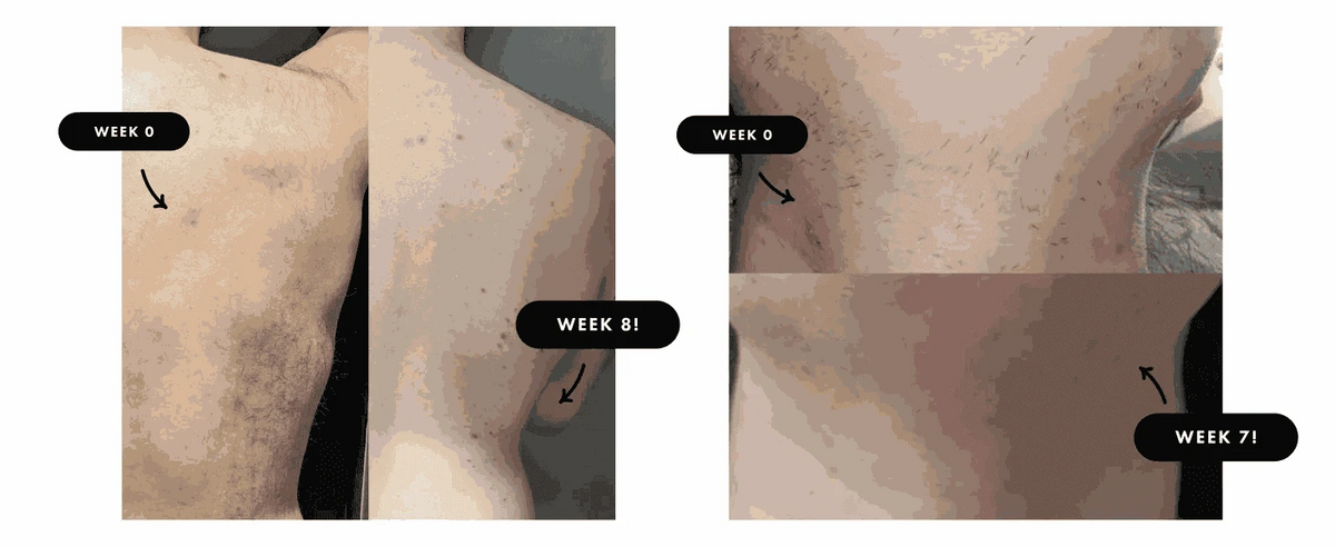 IPL Hair Removal Device with 999,900 Flashes for Full-Body Use-AI01D / US Plug / United States