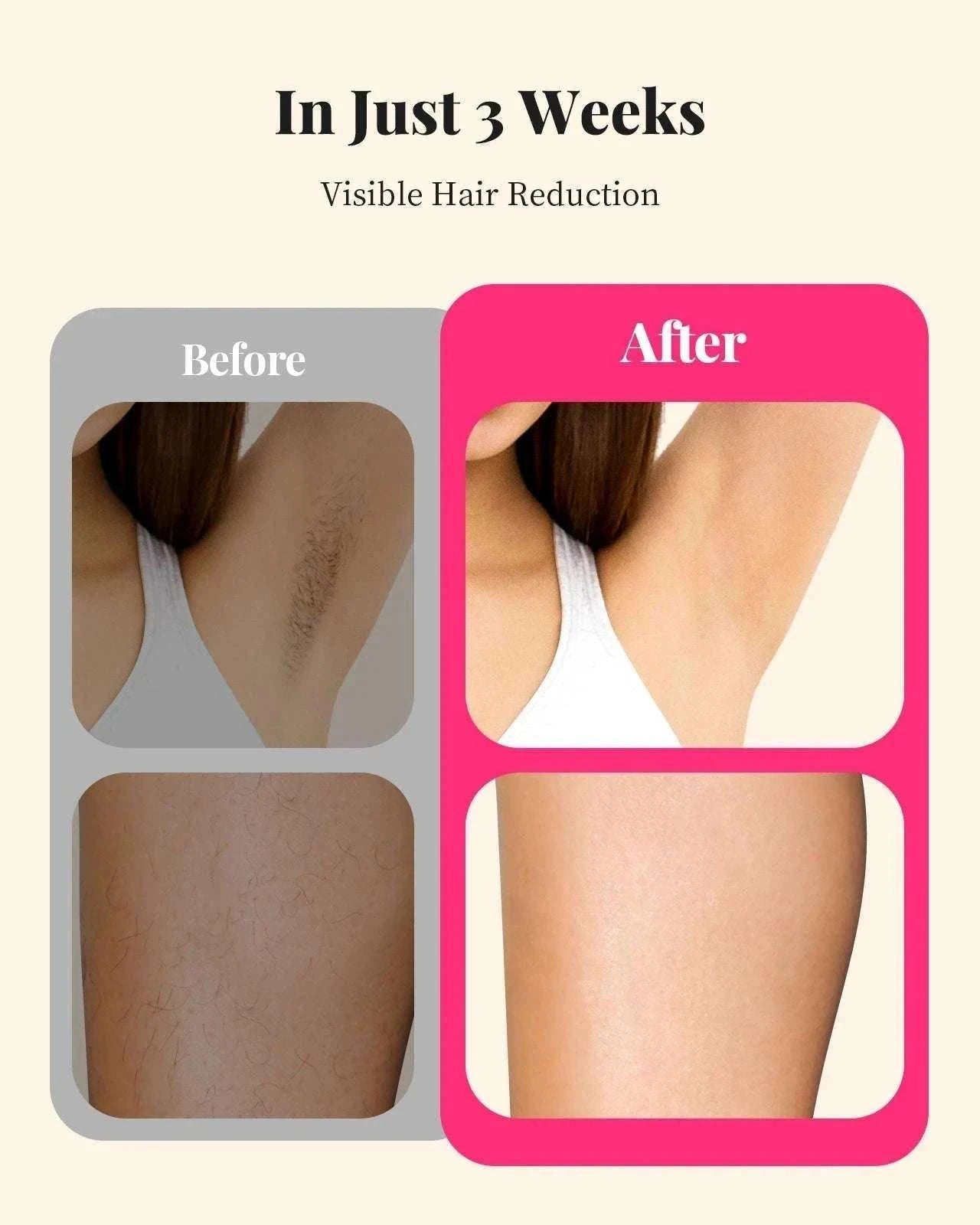 IPL Laser Hair Removal Device 990,000 Flashes for Body, Face & Bikini-